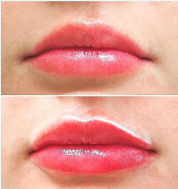 Lips before and after