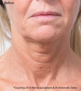 after profhilo, profhilo in sheffield, skin tightening near me