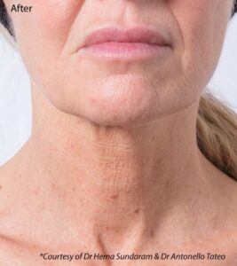 skin tightening near me, profhilo in sheffield