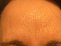Botox, Bocouture, brows photos, anti-wrinkle injection, anti-wrinkle treatment, anti-wrinkle relaxant, after botox, best time to start botox, brows photos,