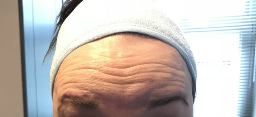 Botox, Bocouture, best time to start botox, antiwrinkle injections, antirwrinkle treatments, botox in barnsley, mobile botox in barnsley, dermal fillers barnsley, lip fillers barnsley, cheek fillers barnsley