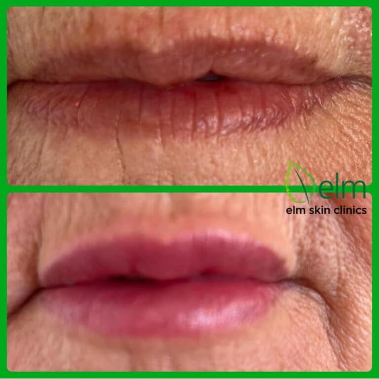 lips before and after