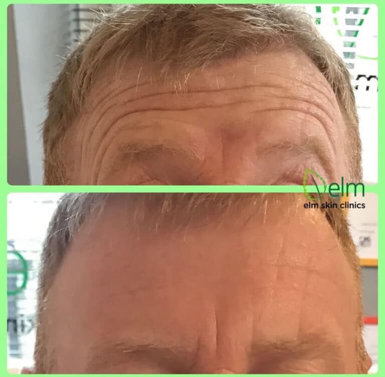 forehead reduced wrinkles before and after
