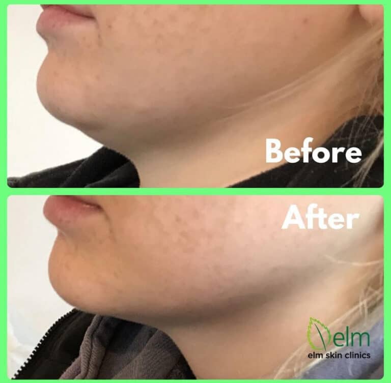 chin augmentation with dermal fillers