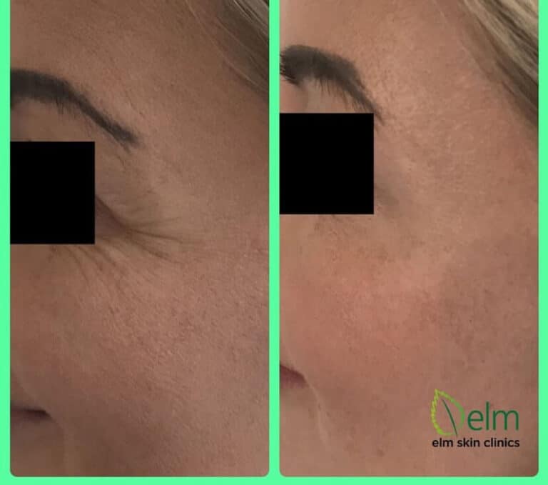 before and after results for Botox treatment
