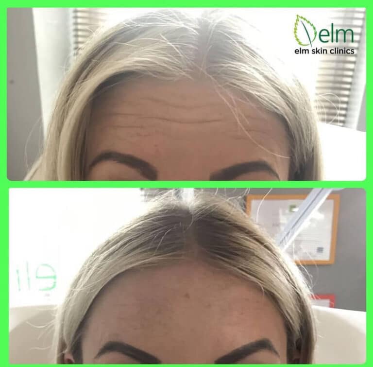 forehead before and after wrinkle reduction