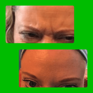 botox near me, botox near me in Sheffield, botox near me in Sheffield and Barnsley, botox treatment sheffield