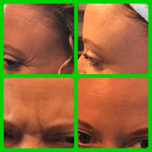 botox, bocouture, botox or bocouture, before and after