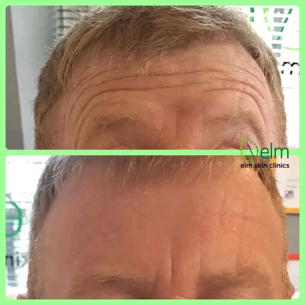 botox for men in sheffield