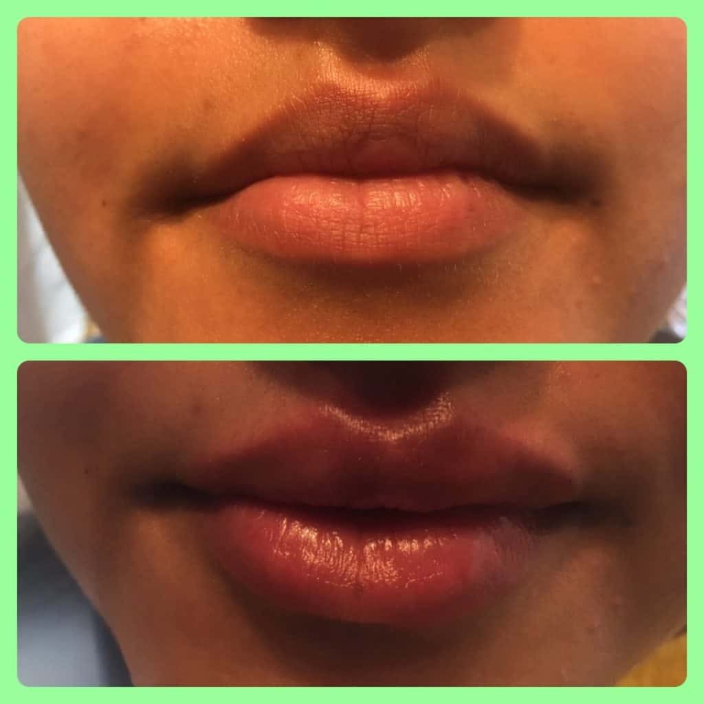 lip fillers in barnsley