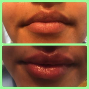lip fillers in barnsley