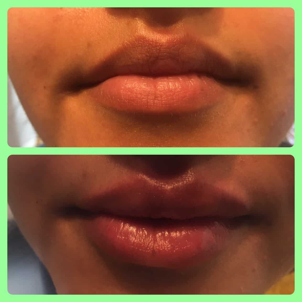lip fillers in barnsley